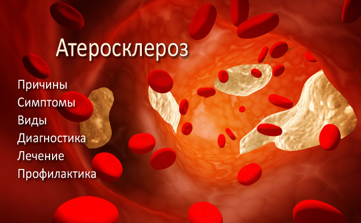 Атеросклероз. Симптомы, причины и лечение атеросклероза - Добро ЕСТЬ ...