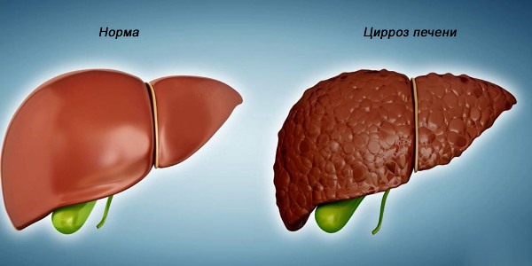 цирроз печени - осложнения гепатита С