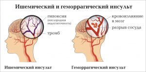 инсульт