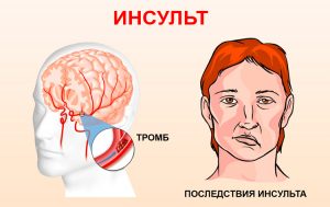 инсульт