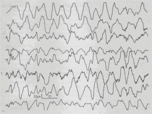 эпилепсия у детей 